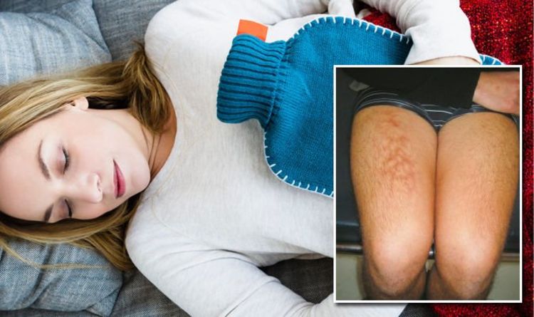 How to Treat a Hot Water Bottle Burn